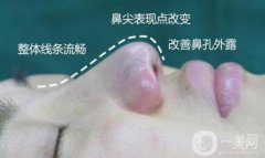 鞍鼻有哪些种类，鞍鼻整形的效果怎么样？