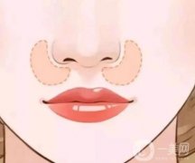 鼻基底填充的方法有哪些，可以改善鼻唇沟吗