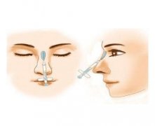玻尿酸填充鼻唇沟有缺点吗？