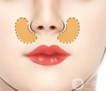 鼻基底填充常见的副作用有哪些