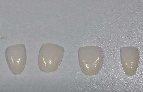 瓷贴面牙齿价格：了解瓷贴面牙齿美容的费用和优势