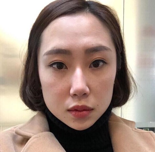 下颌角整形100天真人案例巴掌小脸轻松get