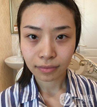找北京世熙丁砚江做了自体脂肪面部填充+双眼皮手术分享
