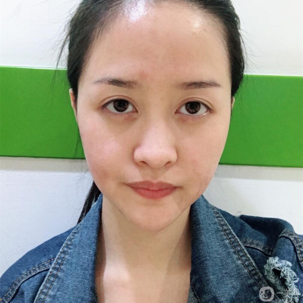 上海华美鼻部综合手术 心路历程分享