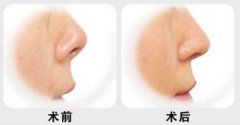 北京自体垫鼻子要花多少钱？自体垫鼻子费用大概是多少？