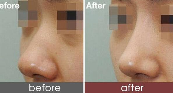 隆鼻多久消肿自然，术后多久能恢复？