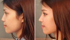 北京膨体隆鼻价格是多少？膨体隆鼻手术多少钱？