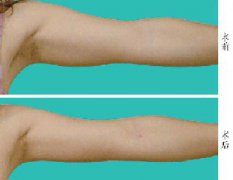 手臂吸脂术后多久能恢复自然，手臂吸脂多久消肿？