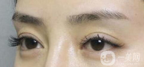 上海自体脂肪丰眉弓价格、自体脂肪丰眉弓多少钱