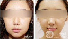 改脸型要多少钱？改脸型价格是多少？