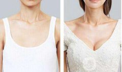 妙桃假体隆胸多少钱？妙桃假体隆胸价格？