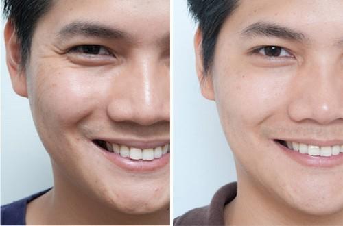 去鱼尾纹的方法有哪些？玻尿酸去鱼尾纹怎么样？