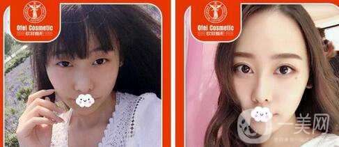 李文祥双眼皮案例