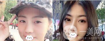 李文祥眼*整形案例