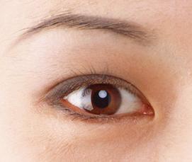 生物焊接双眼皮是什么？有什么特点？