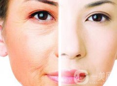 光子嫩肤的果如何、光子嫩肤到底怎么样？