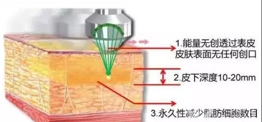 做超声波吸脂手术的时候疼吗？