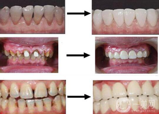 烤瓷牙的材料有哪些？烤瓷牙*果如何