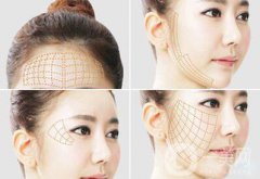*面部提升术详细介绍？*果怎么样