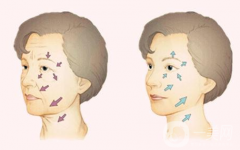 小切口拉皮除皱术果一般能维持几年？