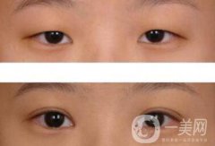 威海割双眼皮多少钱？双眼皮手术价格详解