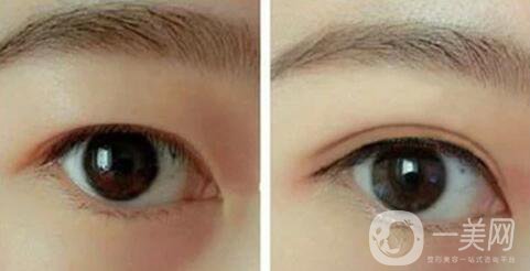 韩式三点双眼皮的缺点详细介绍 手术前后图