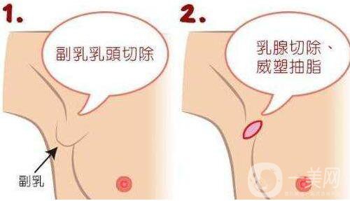 副乳吸脂,多久消肿