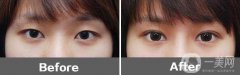 割双眼皮整形医院信息介绍 双眼皮医院如何选择
