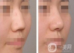驼峰鼻矫正方法介绍 杭州驼峰鼻矫正多少钱
