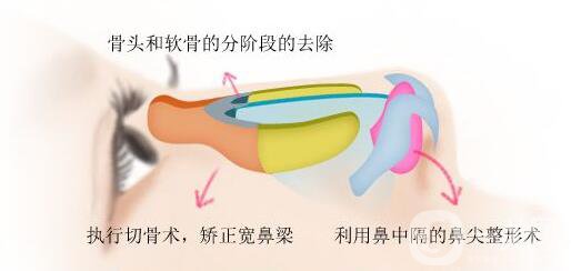 驼峰鼻矫正费用 驼峰鼻矫正价格盘点
