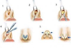 鼻部手术包括哪些项目 鼻部手术过程图