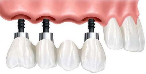 种植牙能用多长时间 种植牙能保持多久