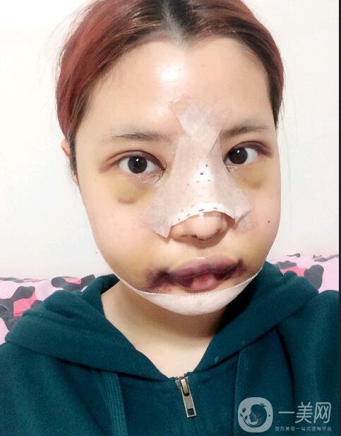 上海美联臣医疗美容朱麟去下颌角术后效果图,巴掌小脸轻松get