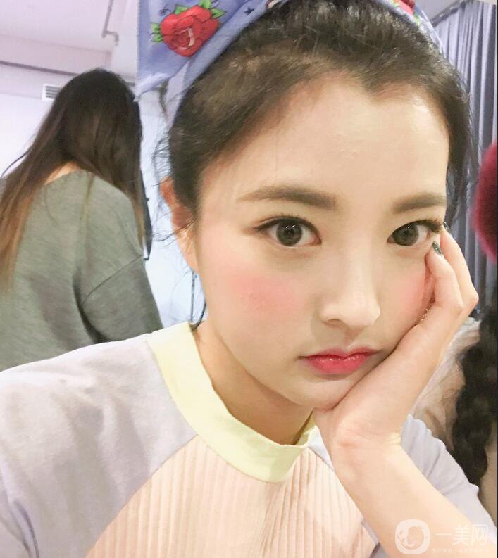 上海美联臣医疗美容朱麟去下颌角术后效果图,巴掌小脸轻松get