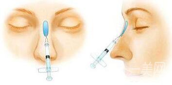 注射隆鼻注意事项 注射隆鼻术后如何护理