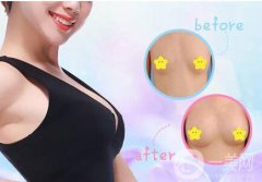 双平面假体丰胸怎么样 双平面假体丰胸好不好