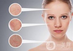 c6激光美容怎么样 c6激光美容好不好