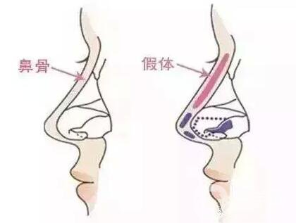 硅胶假体隆鼻怎么样 硅胶隆鼻能保持几年