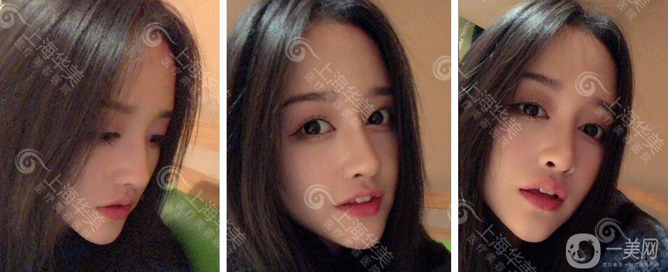 上海华美整形价格表2018发布 高级脸专属定制项目曝光