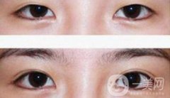 在济南割双眼皮费用是多少