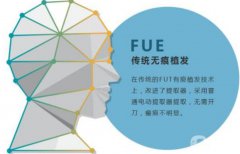 什么是fue植发，fue植发技术果怎么样？