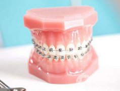 t4a牙齿矫正器佩戴方法