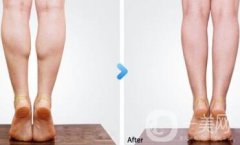 南京注射注射瘦脸注射瘦腿多少钱