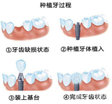 郑州,种植牙,价格