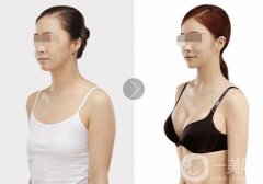 假体隆胸恢复期要多久 假体隆胸轻松拥有网红傲人身材