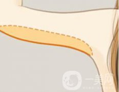 苏州上臂吸脂减肥术一般要多少钱？