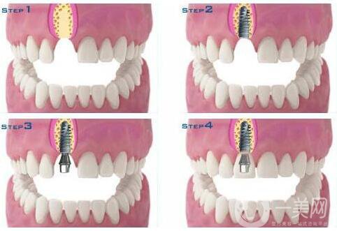 种植牙可以用多久 维持时间解析