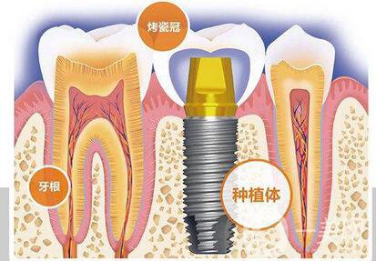 人工种植牙的价格要多少钱？