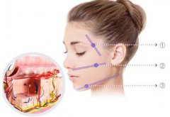 北京非手术面部提升大概需要多少钱?