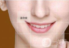 自体脂肪丰鼻唇沟果好吗?术后护理要点有哪些呢?